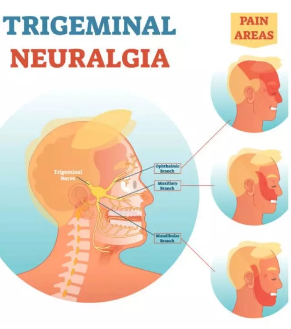 What Is Trigeminal Neuralgia