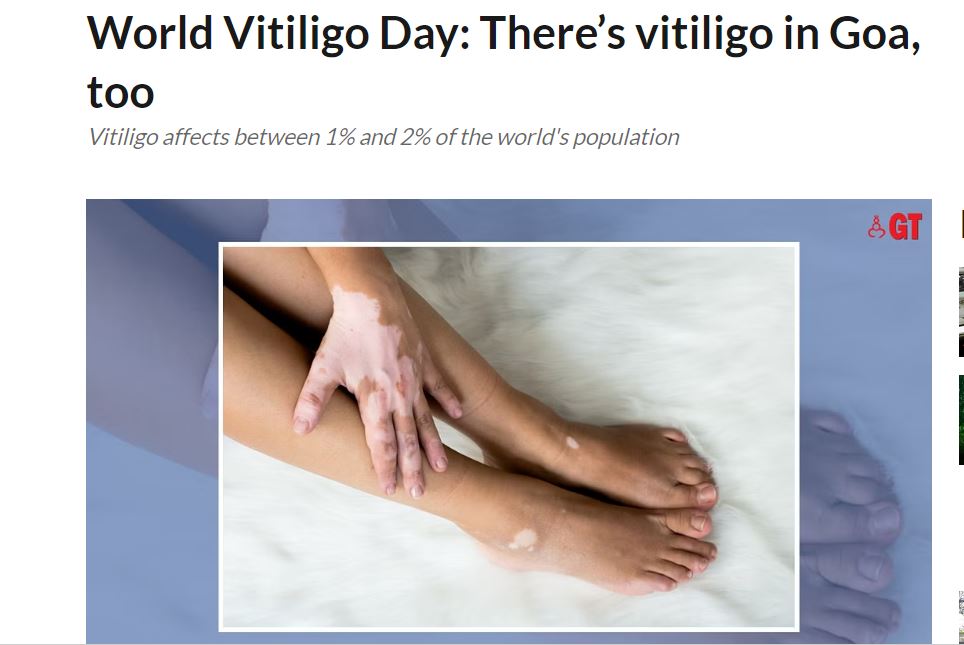  Vitiligo in Goa