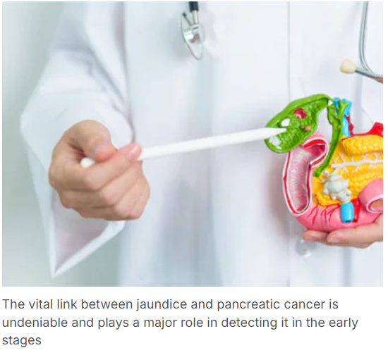 Jaundice and pancreatic cancer