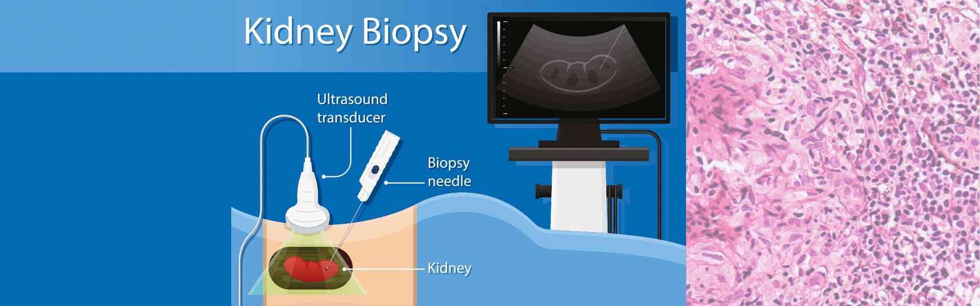 Kidney Biopsy Treatment in Kharadi Pune