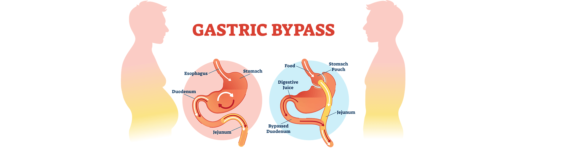 Bariatric surgery in Bangalore 
