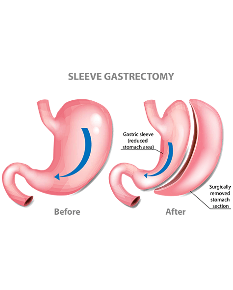 Bariatric Surgery in Millers Road Bangalore