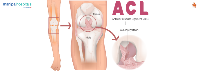 ACL Tear Injury Signs Symptoms Recovery and Prevention