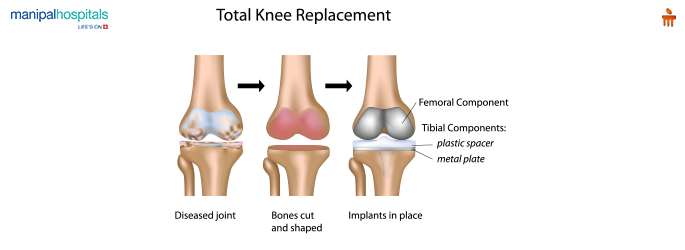 Benefits of Total Knee Replacement