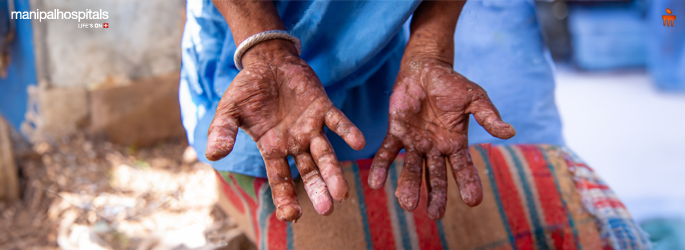 Eradicating Leprosy: Insights & Actions | World Leprosy Day