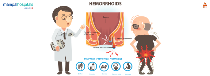 Hemorrhoidectomy: Surgical Treatment for Hemorrhoids