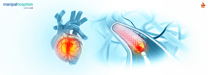 Angioplasty procedure with balloon catheter and stent placement in a coronary artery.