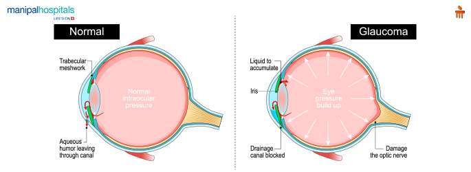 Glaucoma: Causes, Prevention, and Treatment