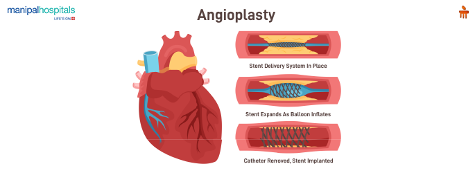 Advancements in Coronary Angioplasty: How Technology is Transforming