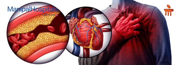 Heart Attack Causes And Treatment