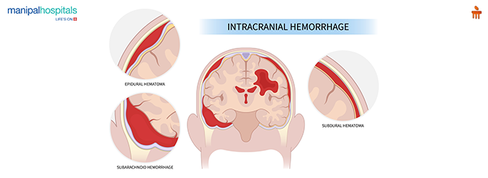 Brain Hemorrhage: Causes, Symptoms & Treatment