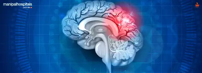 Blood Clot in Brain : Symptoms, Treatments & Causes - KMC Manipal