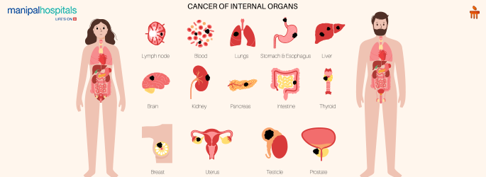 Early Symptoms of Cancer