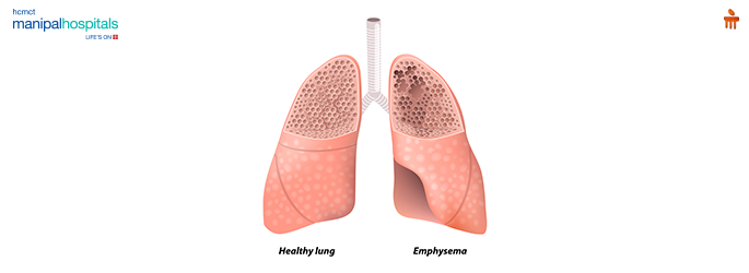 Emphysema: Causes, Symptoms, Diagnosis & Treatment