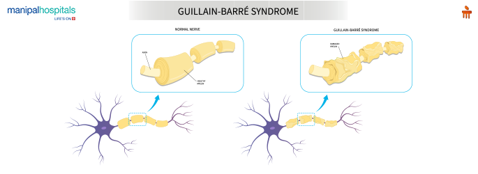 Guillain Barré Syndrome Symptoms