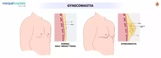 Gynecomastia What everyone should know Manipal Hospitals