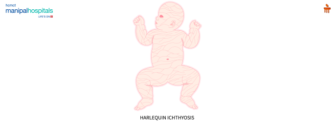 Harlequin Fetus: Causes, Symptoms, and Diagnosis