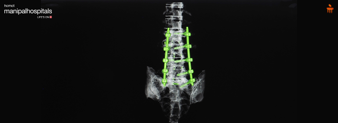 Introduction to OLIF Spine Surgery