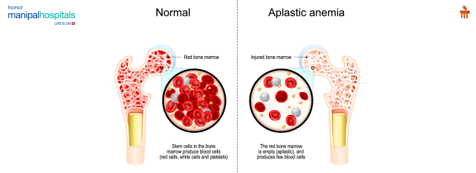 Latest Blood Cancer Treatments BMT CAR-T cell Therapy