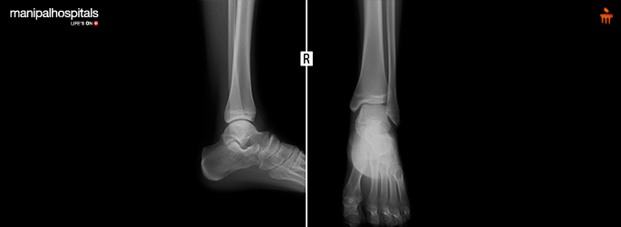 Managing Simple Bone Cysts: Diagnosis to Recovery Guide