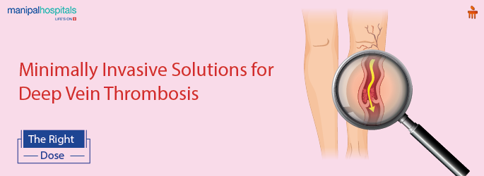 Thrombolysis dissolving a blood clot