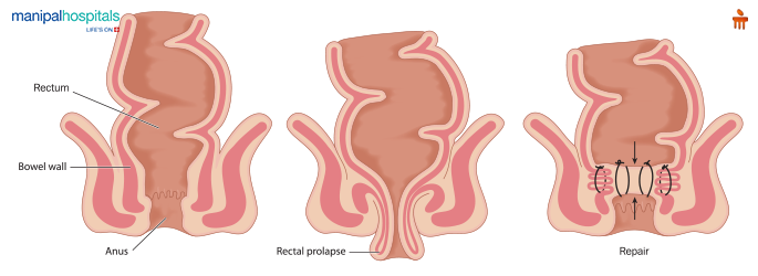 Rectal Prolapse It's Symptoms, Causes & Treatment