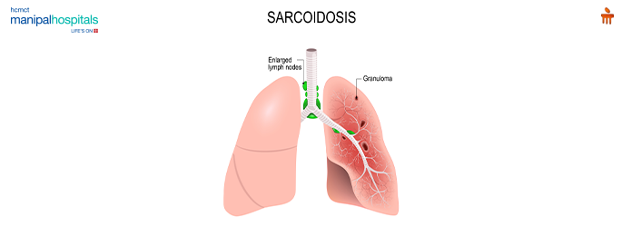 Sarcoidosis Disease It's Causes, Symptoms,Treatment