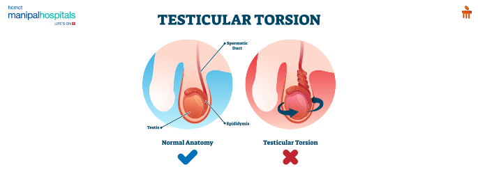 Testicular torsion illustration showing twisted spermatic cord and affected testicle