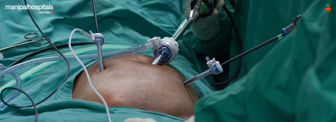 Tips for a Smooth Recovery After Ventral Hernia Surgery