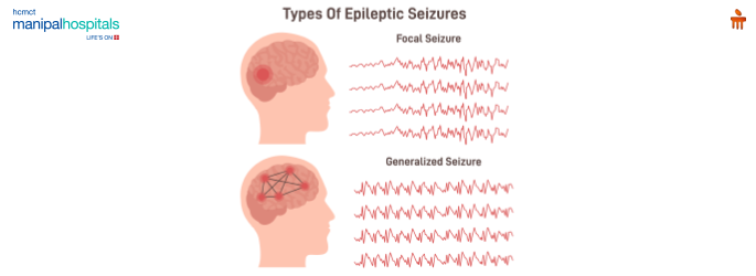 Understanding Epilepsy: Comprehensive Guide to Seizures, Management, and Support