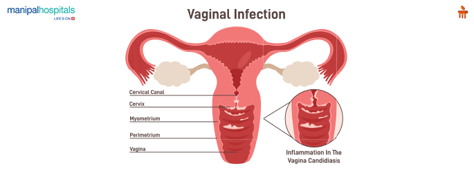 Vaginal yeast infection