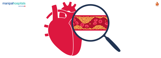 What is High Cholesterol? : Symptoms, Causes and Treatment