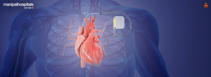 Cardiac Device Implantation Guide