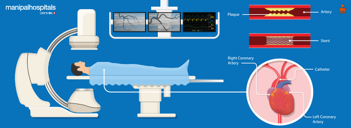 When Should You Get An Angiography