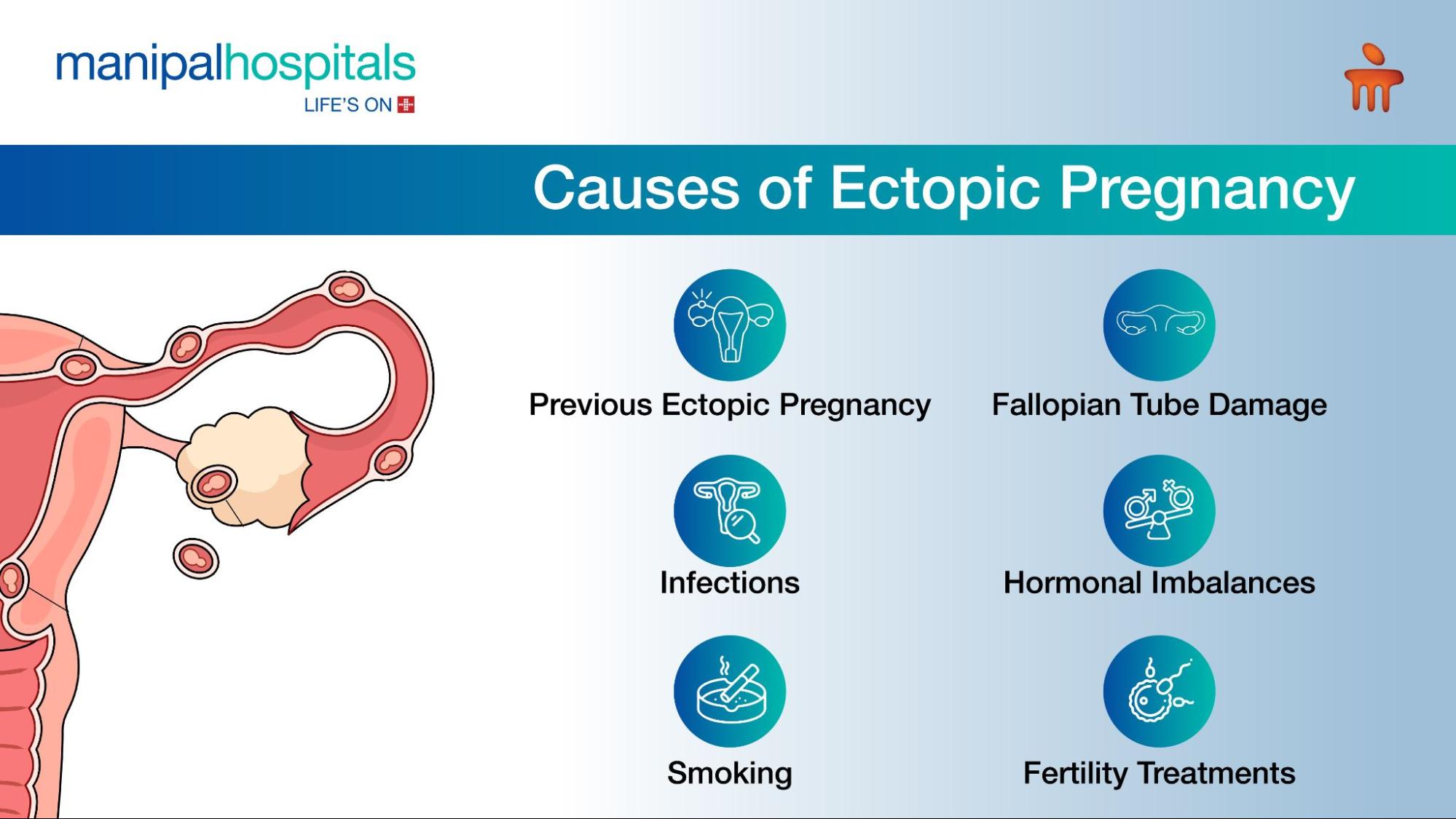 Ectopic-Pregnancy-What-You-Need-to-Know