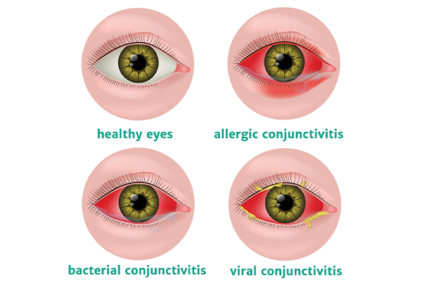 eye infection symptoms