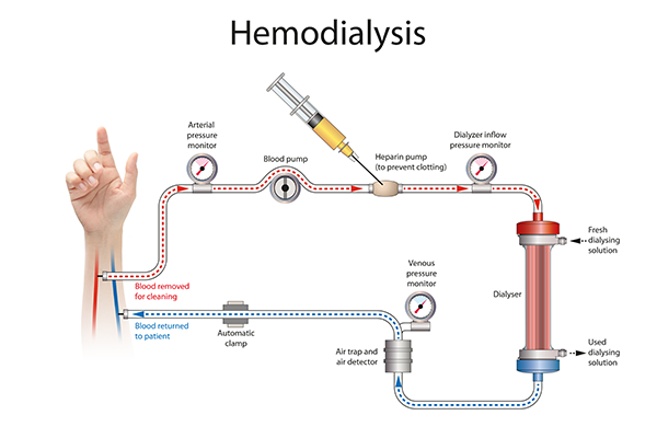 Signs You Need Dialysis and How to Prevent Kidney Failure