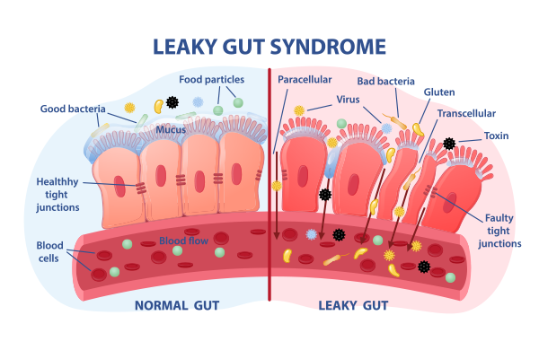 Leaky Gut Syndrome: Symptoms, Causes, Types & Treatment