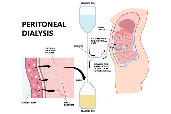 Dialysis: When and Why It's Needed 