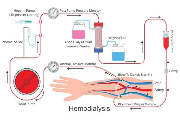 Dialysis: When and Why It's Needed 