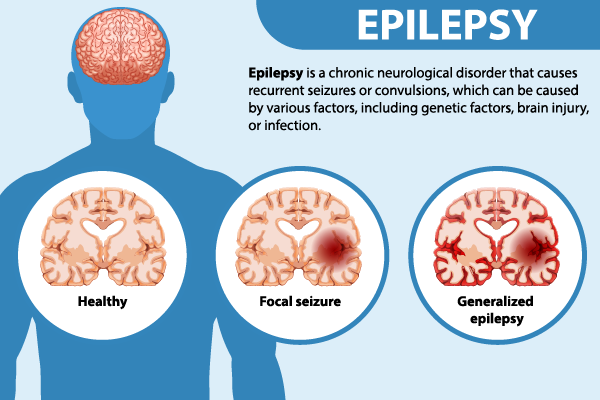 Understanding Epilepsy: Comprehensive Guide to Seizures, Management, and Support