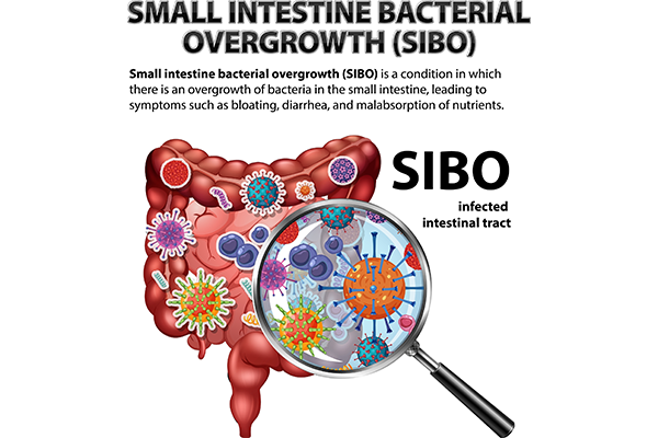 What Is SIBO? Symptoms, Cure, and Best Diet Plan