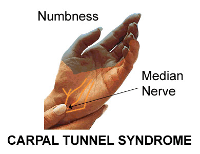 carpul_tunnel_syndrome