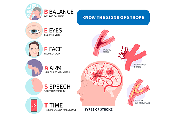 Brain Stroke Symptoms