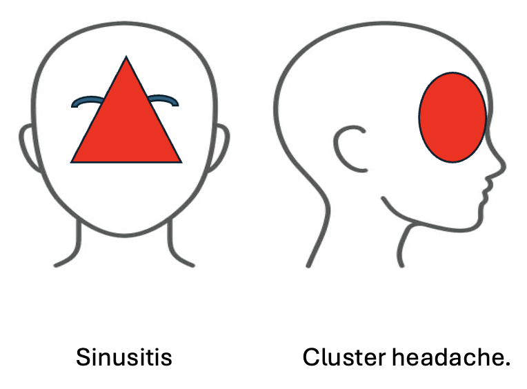 Cluster headache