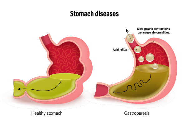 Gastroparesis