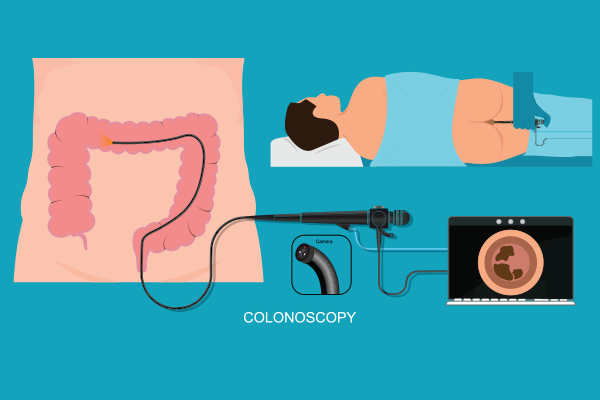 Importance of Colonoscopy for Early Detection of Colon Cancer