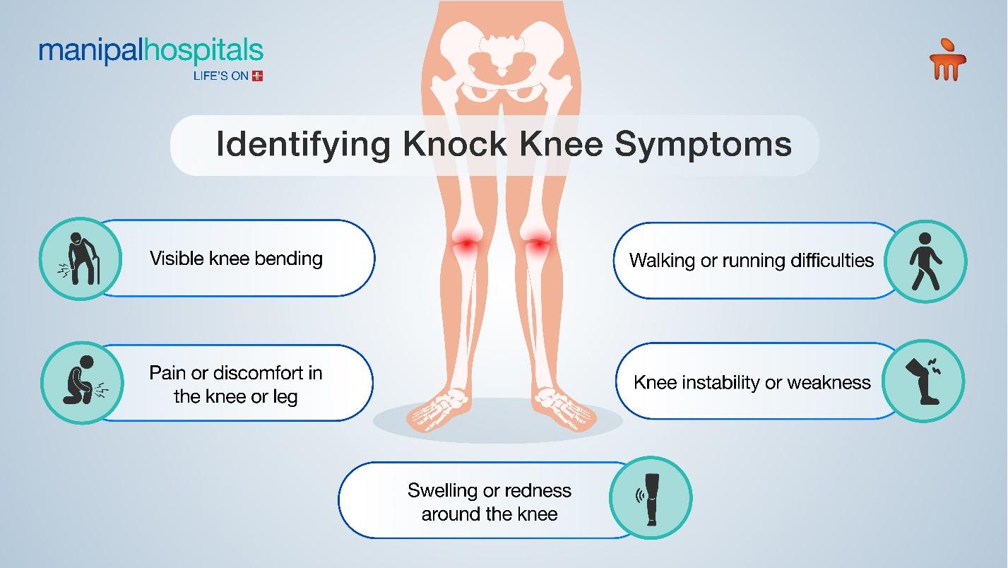 Symptoms of Knock Knee