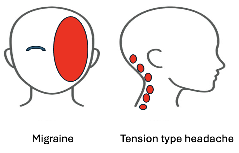 Tension type headach