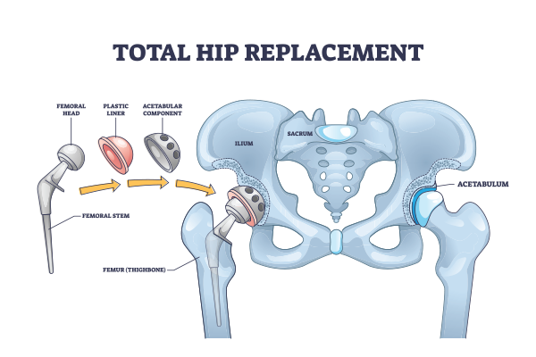 Advanced Techniques in Total Hip Replacement